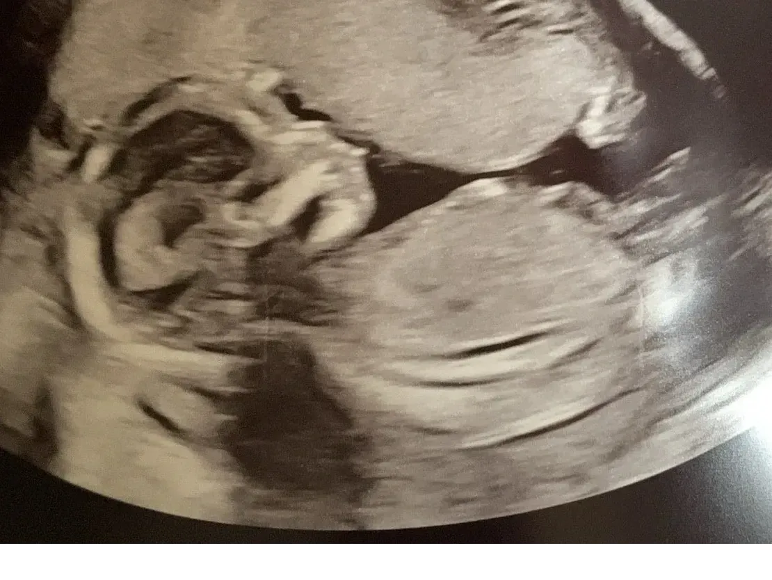Fetal ultrasound with visible head and limbs