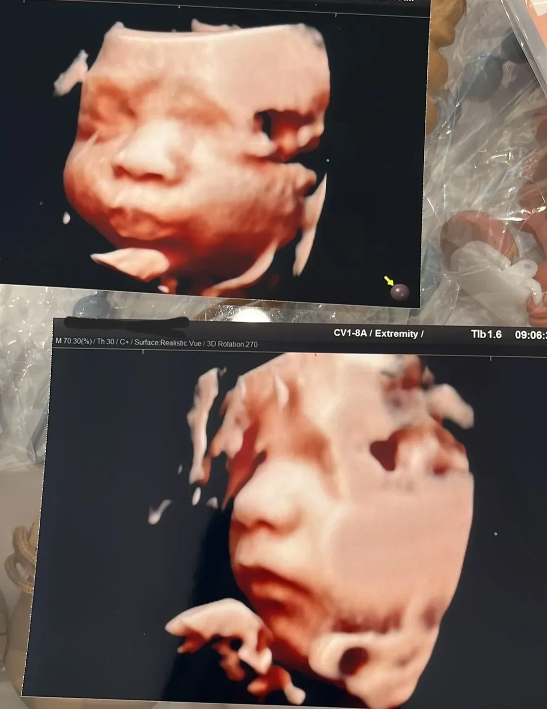Prenatal ultrasound imaging